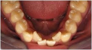 apinhamento-dental-inferior-300x165.jpg